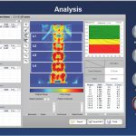 سنجش تراکم استخوان BMD برند OsteoSys دنسیتومتری