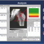 سنجش تراکم استخوان BMD برند OsteoSys دنسیتومتری
