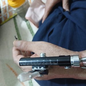 اکسترنال فیکساتور مچ دست  ساق دست